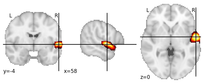 Component 252: Superior temporal gyrus superior RH