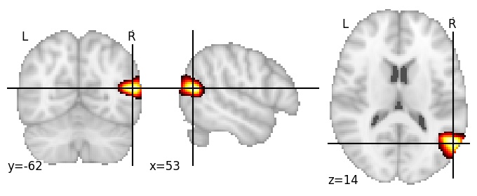 Component 283: Lateral occipital cortex antero-superior RH