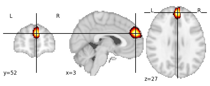 Component 291: Dorsomedial prefrontal cortex anterior