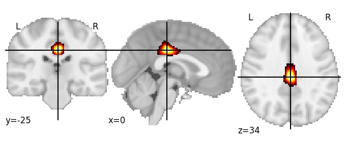 Component 336: Posterior cingulate cortex anterior