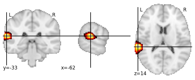 Component 337: Superior temporal gyrus posterior LH