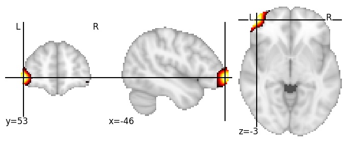 Component 356: Inferior frontal gyrus anterior LH