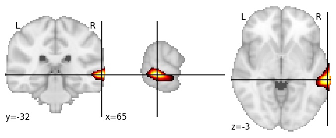 Component 391: Middle temporal gyrus middle RH