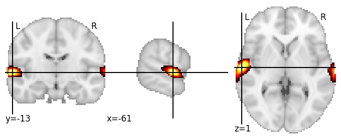 Component 402: Superior temporal gyrus middle LH