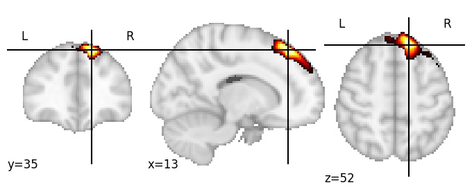 Component 43: Superior frontal gyrus superior RH