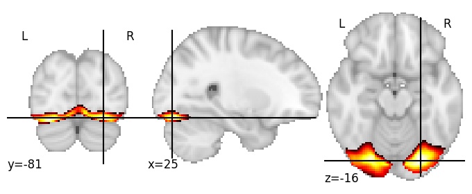 Component 29: Inferior occipital gyrus
