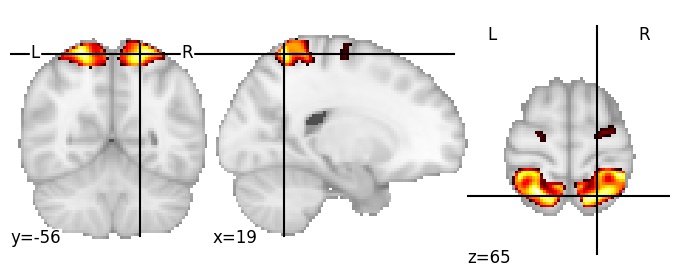 Component 33: Superior parietal lobule anterior
