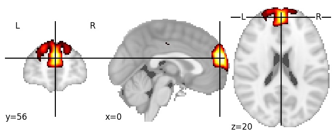 Component 39: Dorsomedial prefrontal cortex antero-superior