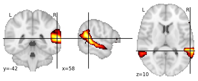 Component 7: Superior temporal sulcus with angular gyrus